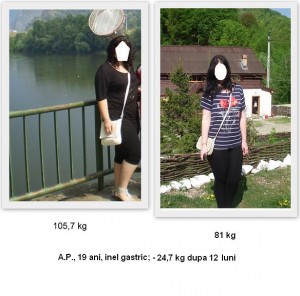 scapa de obezitate, interventii obezitate, consultatie online obezitate, micsorare stomac, inel gastric, pret micsorare stomac,