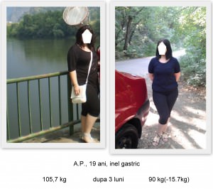 scapa de obezitate, interventii obezitate, consultatie online obezitate, micsorare stomac, inel gastric, pret micsorare stomac,