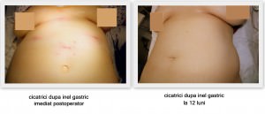 scapa de obezitate, interventii obezitate, consultatie online obezitate, micsorare stomac, inel gastric, pret micsorare stomac,