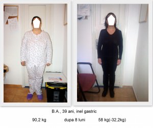 scapa de obezitate, interventii obezitate, consultatie online obezitate, micsorare stomac, inel gastric, pret micsorare stomac,