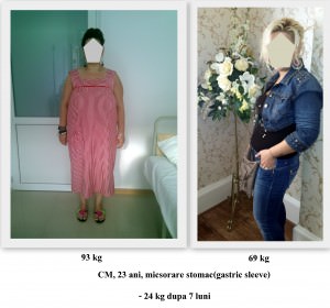 scapa de obezitate, interventii obezitate, consultatie online obezitate, micsorare stomac, inel gastric, pret micsorare stomac,