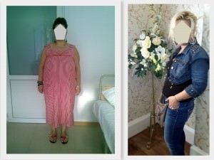 scapa de obezitate, interventii obezitate, consultatie online obezitate, micsorare stomac, inel gastric, pret micsorare stomac,