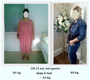 scapa de obezitate, interventii obezitate, consultatie online obezitate, micsorare stomac, inel gastric, pret micsorare stomac,