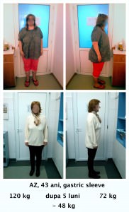 scapa de obezitate, interventii obezitate, consultatie online obezitate, micsorare stomac, inel gastric, pret micsorare stomac,