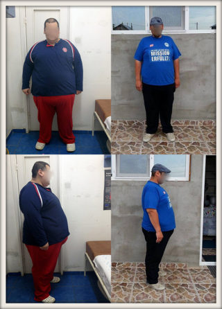 scapa de obezitate, interventii obezitate, consultatie online obezitate, micsorare stomac, inel gastric, pret micsorare stomac,