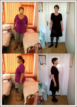 scapa de obezitate, interventii obezitate, consultatie online obezitate, micsorare stomac, inel gastric, pret micsorare stomac,