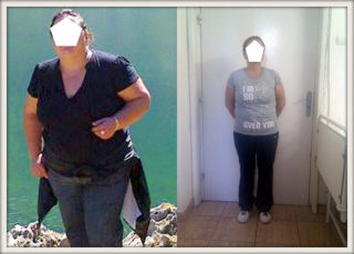 scapa de obezitate, interventii obezitate, consultatie online obezitate, micsorare stomac, inel gastric, pret micsorare stomac,