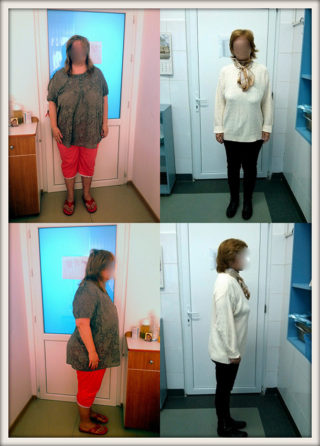 scapa de obezitate, interventii obezitate, consultatie online obezitate, micsorare stomac, inel gastric, pret micsorare stomac,