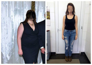 scapa de obezitate, interventii obezitate, consultatie online obezitate, micsorare stomac, inel gastric, pret micsorare stomac,