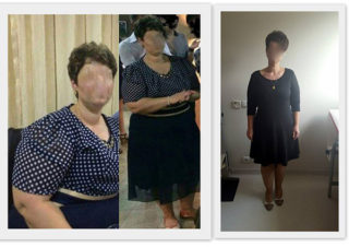 scapa de obezitate, interventii obezitate, consultatie online obezitate, micsorare stomac, inel gastric, pret micsorare stomac,