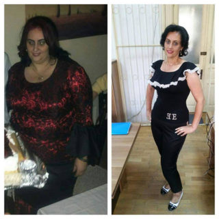scapa de obezitate, interventii obezitate, consultatie online obezitate, micsorare stomac, inel gastric, pret micsorare stomac,