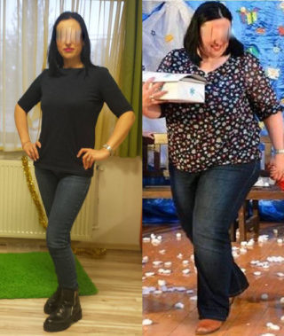 scapa de obezitate, interventii obezitate, consultatie online obezitate, micsorare stomac, inel gastric, pret micsorare stomac,