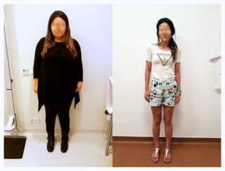 scapa de obezitate, interventii obezitate, consultatie online obezitate, micsorare stomac, inel gastric, pret micsorare stomac,