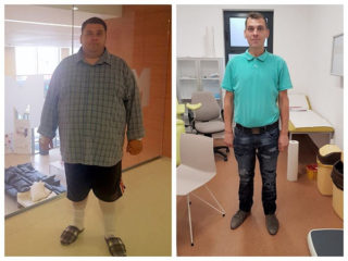 scapa de obezitate, interventii obezitate, consultatie online obezitate, micsorare stomac, inel gastric, pret micsorare stomac,