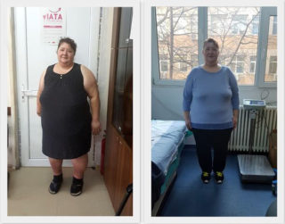 scapa de obezitate, interventii obezitate, consultatie online obezitate, micsorare stomac, inel gastric, pret micsorare stomac,