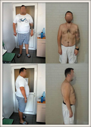 scapa de obezitate, interventii obezitate, consultatie online obezitate, micsorare stomac, inel gastric, pret micsorare stomac,