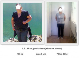 scapa de obezitate, interventii obezitate, consultatie online obezitate, micsorare stomac, inel gastric, pret micsorare stomac,