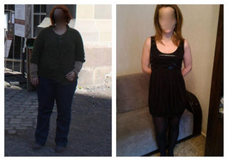 scapa de obezitate, interventii obezitate, consultatie online obezitate, micsorare stomac, inel gastric, pret micsorare stomac,