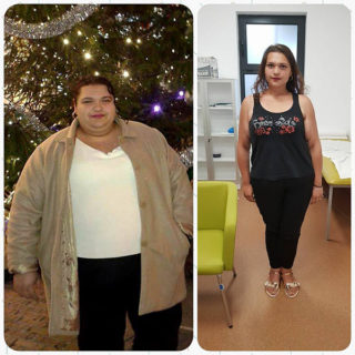scapa de obezitate, interventii obezitate, consultatie online obezitate, micsorare stomac, inel gastric, pret micsorare stomac,