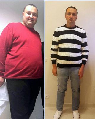 scapa de obezitate, interventii obezitate, consultatie online obezitate, micsorare stomac, inel gastric, pret micsorare stomac,