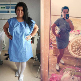 scapa de obezitate, interventii obezitate, consultatie online obezitate, micsorare stomac, inel gastric, pret micsorare stomac,
