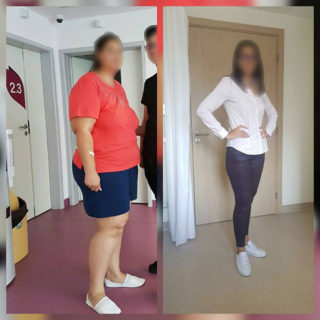 scapa de obezitate, interventii obezitate, consultatie online obezitate, micsorare stomac, inel gastric, pret micsorare stomac,
