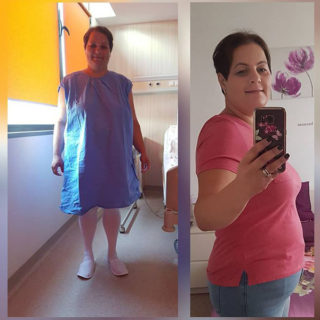 scapa de obezitate, interventii obezitate, consultatie online obezitate, micsorare stomac, inel gastric, pret micsorare stomac,