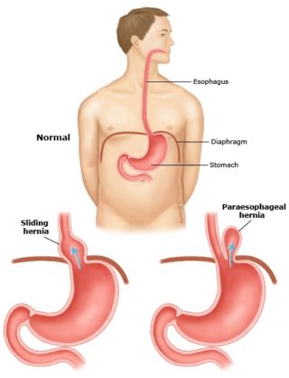 scapa de obezitate, interventii obezitate, consultatie online obezitate, micsorare stomac, inel gastric, pret micsorare stomac,